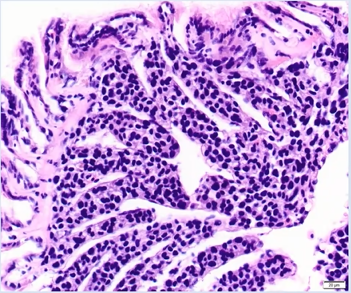 Hard clam hemocytic neoplasia