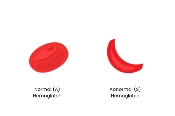 Side by side of two red blood cells. Left labeled Normal A hemoglobin is round and disc shaped; right labeled Abnormal S sickle