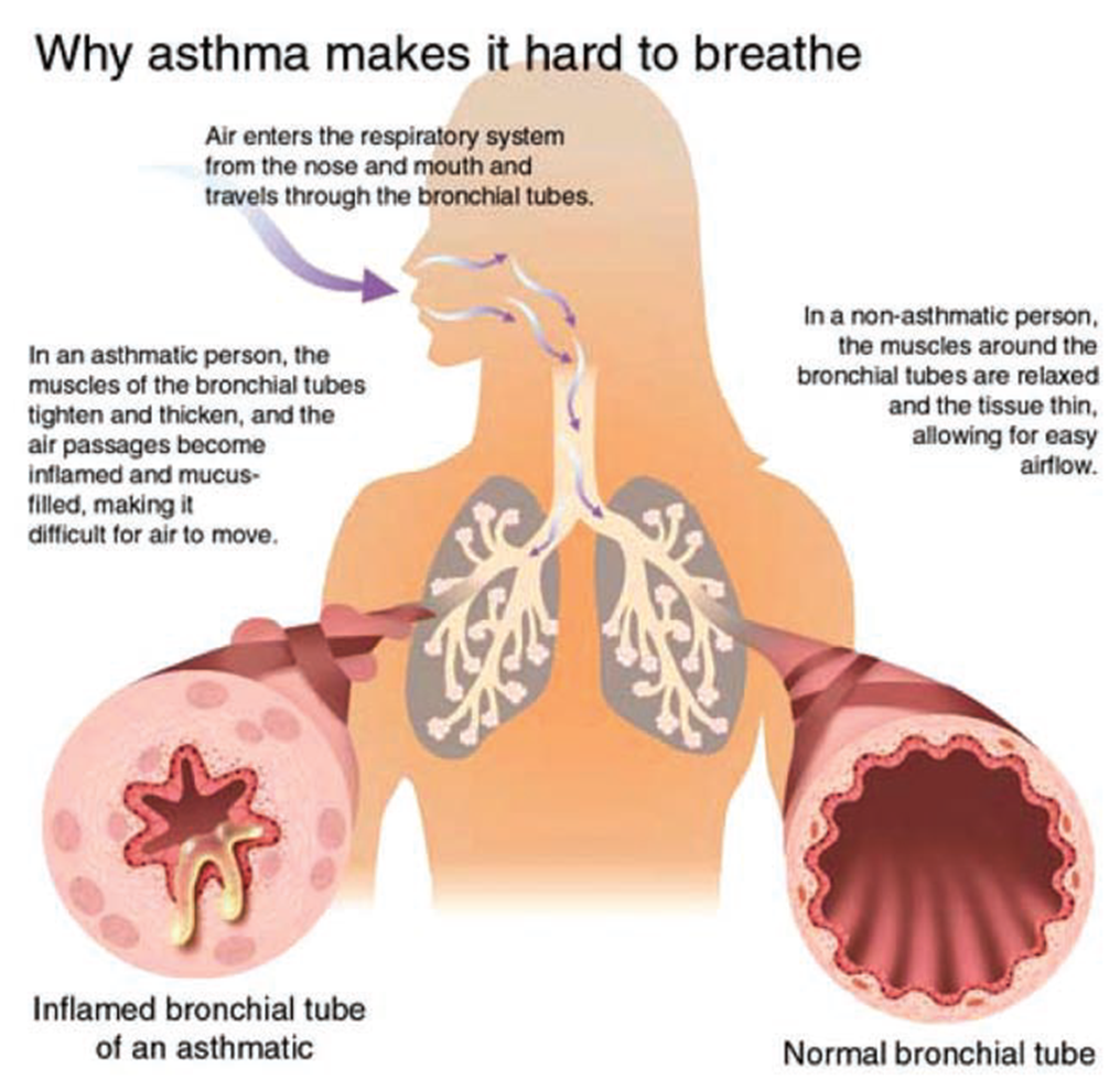 What Is Asthma