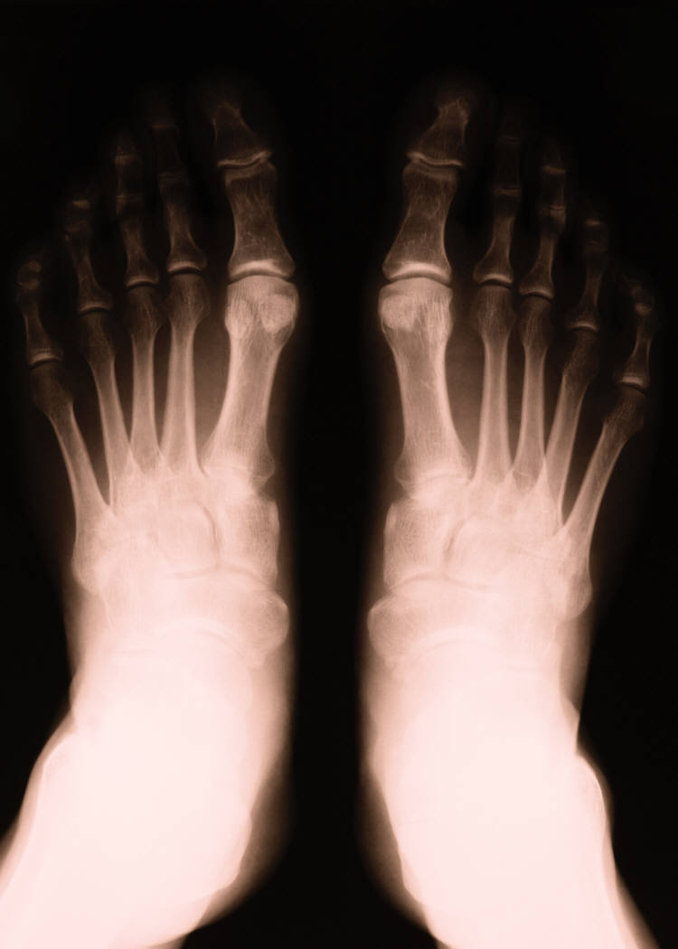 X-ray of feet